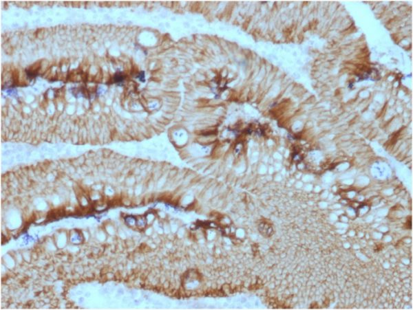 Formalin-fixed, paraffin-embedded human rectal massstained with EpCAM Mouse Monoclonal Antibody (EGP40/1373).