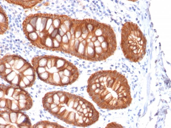 Formalin-fixed, paraffin-embedded human Colon Carcinoma stained with EpCAM Mouse Recombinant Monoclonal Antibody (rVU-1D9).