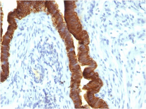 Formalin-fixed, paraffin-embeddedhuman ovarian carcinoma stained with EpCAM Mouse Recombinant Monoclonal Antibody (rEGP40/1110).