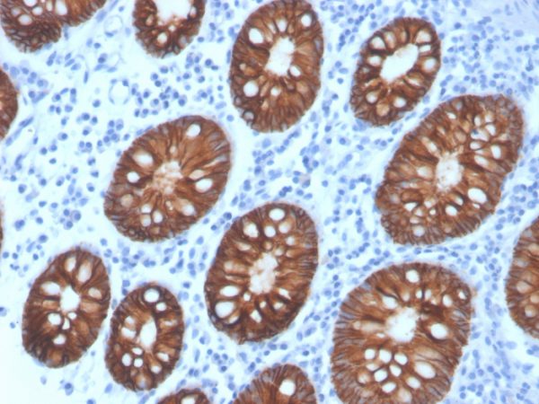 Formalin-fixed, paraffin-embedded human colon carcinoma stained with EpCAM Recombinant Mouse Monoclonal Antibody (rEGP40/4547).