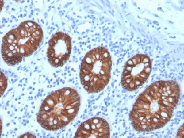 Formalin-fixed, paraffin-embedded human colon carcinoma stained with EpCAM Recombinant Mouse Monoclonal Antibody (rEGP40/4547).