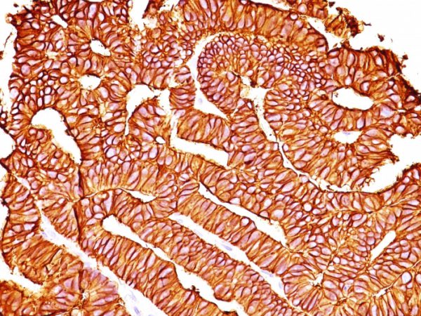 Formalin-fixed, paraffin-embedded human Colon Carcinoma stained with Ep-CAM Ab (SPM528).