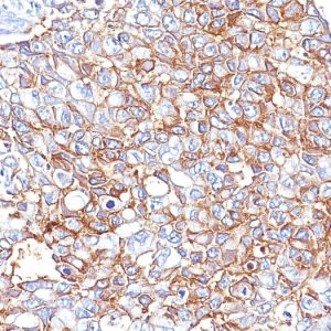 Formalin-fixed, paraffin-embedded human breast carcinoma stained with EpCAM Mouse Monoclonal Antibody (PAN-EpCAM).