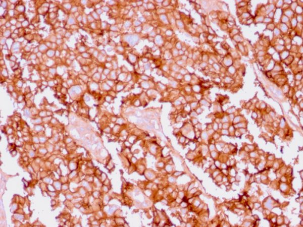 Formalin-fixed, paraffin-embedded human Ovary stained with EpCAM Rabbit Recombinant Monoclonal Antibody (EGP40/1556R).