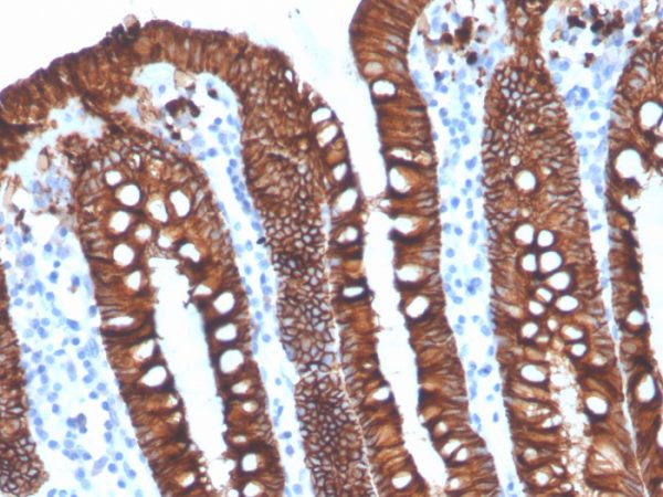 Formalin-fixed, paraffin-embedded human ovarian carcinoma stained with EpCAM Recombinant Rabbit Monoclonal Antibody (EGP40/4546R).