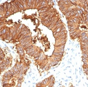 Formalin-fixed, paraffin-embedded human colon stained with EpCAM Rabbit Recombinant Monoclonal Antibody (EGP40/7035R). HIER: Tris/EDTA, pH9.0, 45min. 2°C: HRP-polymer, 30min. DAB, 5min.