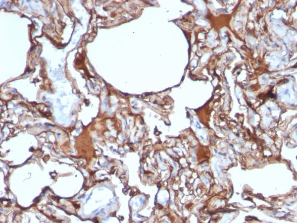 Formalin-fixed, paraffin-embedded human Melanoma stained with MCAM Monoclonal Antibody (SPM620)