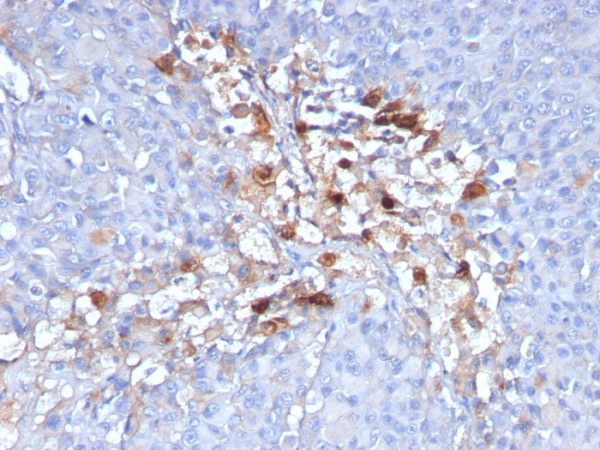 Formalin-fixed, paraffin-embedded human Melanoma stained with CD146 Monoclonal Antibody (C146/634)