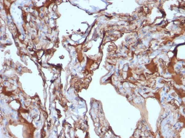 Formalin-fixed, paraffin-embedded human Melanoma stained with MUC18 Mouse Monoclonal Antibody (MUC18/1130).