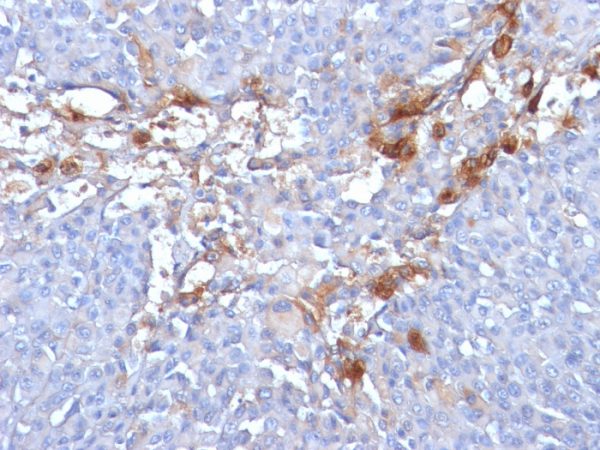 Formalin-fixed, paraffin-embedded human Melanoma stained with MUC18 Mouse Monoclonal Antibody (MUC18/1130).