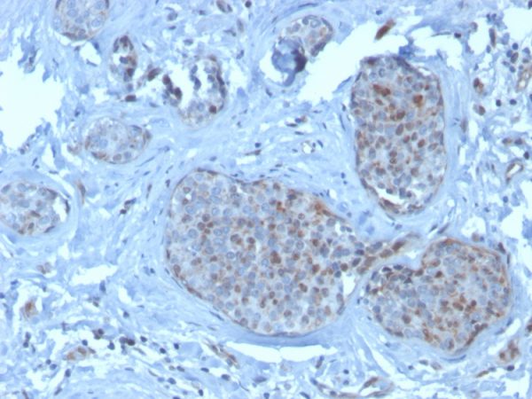 Formalin-fixed, paraffin-embedded human breast carcinoma stained with MDM2 Mouse Monoclonal Antibody (SMP14).