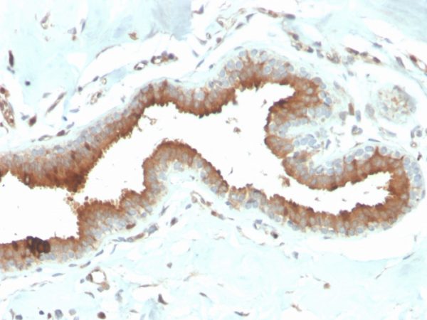 Formalin-fixed, paraffin-embedded human breast carcinoma stained with Mammaglobin Mouse Monoclonal Antibody (MGB/2704).