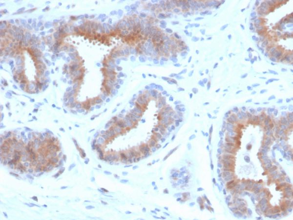 Formalin-fixed, paraffin-embedded human breast carcinoma stained with Mammaglobin Recombinant Mouse Monoclonal Antibody (rMGB/4299).