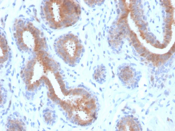 Formalin-fixed, paraffin-embedded human breast carcinoma stained with Mammaglobin Recombinant Mouse Monoclonal Antibody (rMGB/4299).