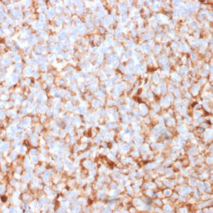Formalin-fixed, paraffin-embedded human breast carcinoma stained with Mammaglobin Recombinant Rabbit Monoclonal Antibody (MGB/2682R).