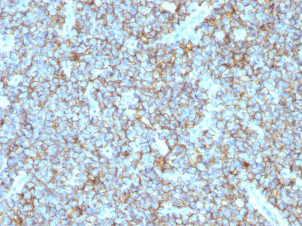 Formalin-fixed, paraffin-embedded human Ewing&apos;s sarcoma stained with CD99 Monoclonal Antibody (MIC2/877).