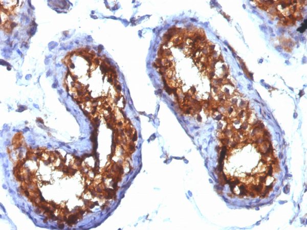 Formalin-fixed, paraffin-embedded human Testicular Carcinoma stained with CD99 Monoclonal Antibody (MIC2/877).