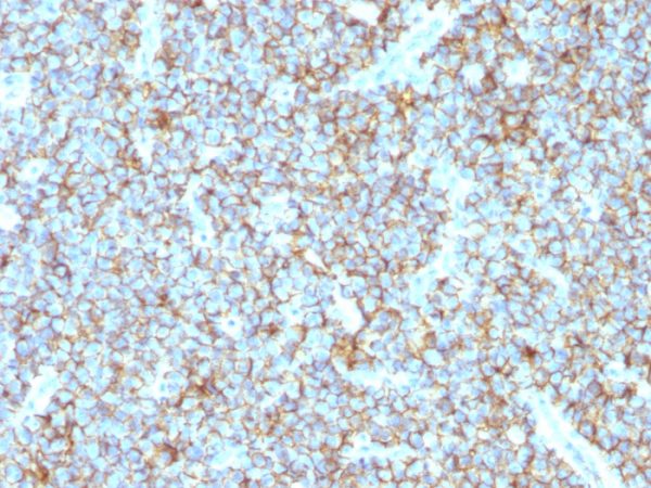 Formalin-fixed, paraffin-embedded human Ewing&apos;s Sarcoma stained with CD99 Rabbit Recombinant Monoclonal Antibody (MIC2/1495R).