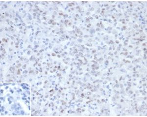 IHC analysis of FFPE Lynch Syndrome / Hereditary Non-Polyposis Colorectal Cancer (HNPCC). MLH1/6467at 2ug/ml in PBS, 30 min RT. HIER: Tris/EDTA, pH9.0, 45min. 2°C: HRP-polymer, 30min. DAB, 5min.Inset: PBS instead of primary, secondary control.