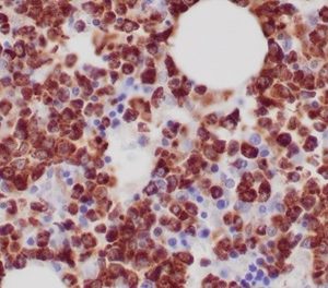 Formalin-fixed, paraffin-embedded human bone marrow stained with Myeloperoxidase Mouse Monoclonal Antibody (MPO/7118).
