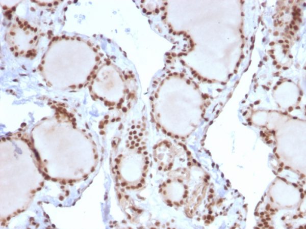 Formalin-fixed, paraffin-embedded human Thyroid Carcinoma stained with MSH2 Mouse Monoclonal Antibody (MSH2/2622).