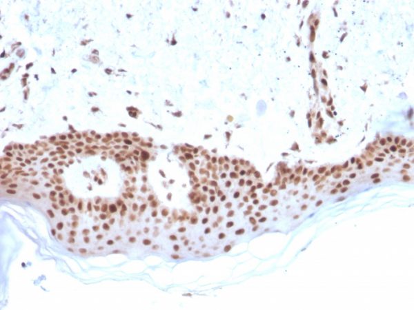 Formalin-fixed, paraffin-embedded human Basal Cell Carcinoma stained with MSH2 Mouse Monoclonal Antibody (MSH2/2622).