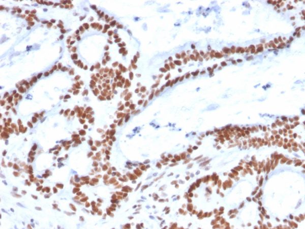 Formalin-fixed, paraffin-embedded human Colon Carcinoma stained with MSH2 Mouse Monoclonal Antibody (MSH2/2622).