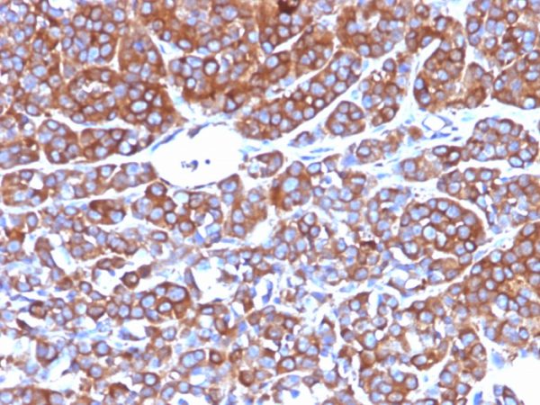 Formalin-fixed, paraffin-embedded human Melanoma stained with Moesin Mouse Monoclonal Antibody (MSN/492).