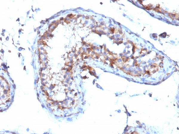 Formalin-fixed, paraffin-embedded human Testicular Carcinoma stained with Moesin Mouse Monoclonal Antibody (MSN/492).