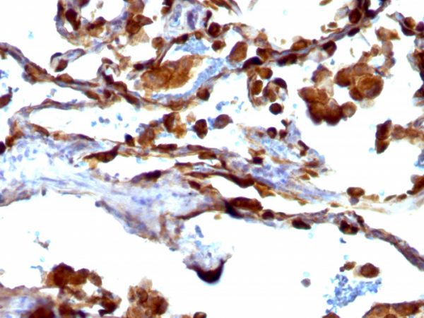 Formalin-fixed, paraffin-embedded human Lung Carcinoma stained with MUC-1 / CA15-3 / EMA Mouse Monoclonal Antibody (VU-4H5).