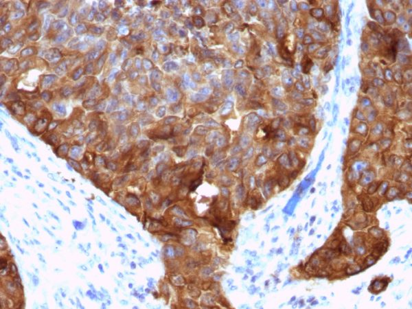 Formalin-fixed, paraffin-embedded human Colon Carcinoma stained with MUC-1 / CA15-3 / EMA Mouse Monoclonal Antibody (VU-4H5).