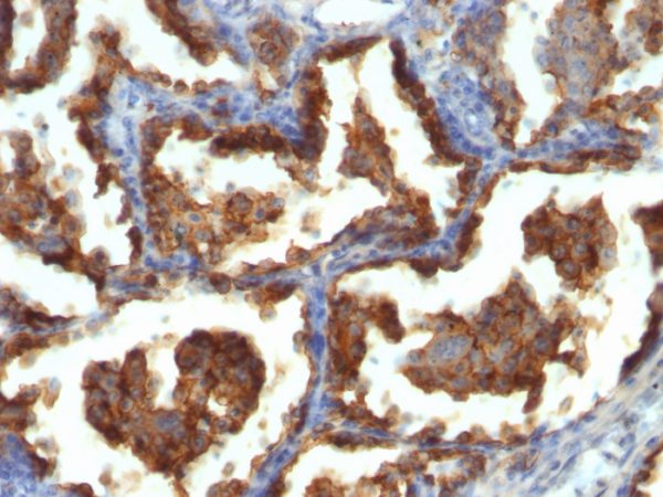 Formalin-fixed, paraffin-embedded human Ovarian Carcinoma stained with MUC-1 / CA15-3 / EMA Mouse Monoclonal Antibody (MUC1/955).