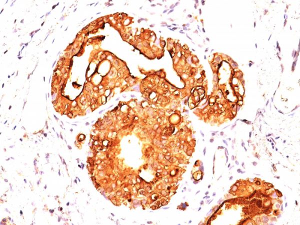 Formalin-fixed, paraffin-embedded human Breast Carcinoma stained with MUC-1 / CA15-3 / EMA Mouse Monoclonal Antibody (MUC1/955).