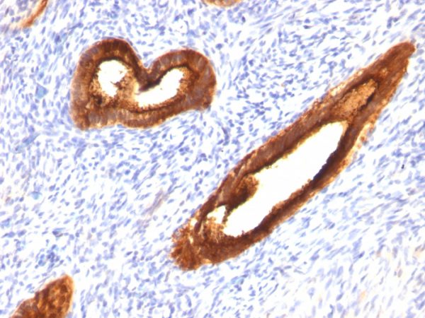 Formalin-fixed, paraffin-embedded human Endometrial Carcinoma stained with MUC-1 / CA15-3 / EMA Mouse Monoclonal Antibody (MUC1/520).