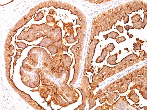 Formalin-fixed, paraffin-embedded human Breast Carcinoma stained with MUC-1 / EMA Mouse Monoclonal Antibody (MUC1/520)