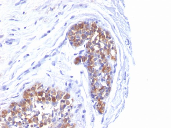 Formalin-fixed, paraffin-embedded human Breast Carcinoma stained with MUC-1 / EMA Mouse Monoclonal Antibody (MUC1/520).