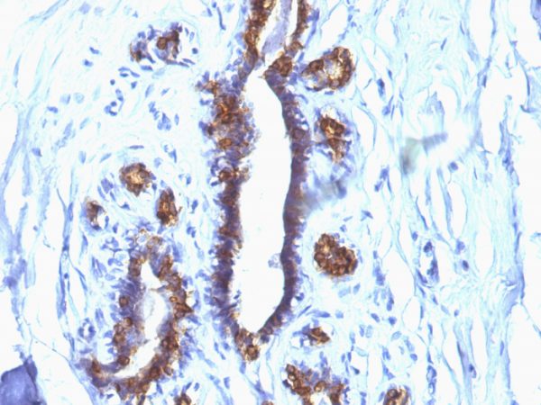 Formalin-fixed, paraffin-embedded human Breast Carcinoma stained with MUC-1 / CA15-3 / EMA Mouse Monoclonal Antibody (SPM132).