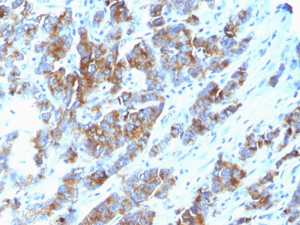 Formalin-fixed, paraffin-embedded human Breast Carcinoma stained with MUC-1 / CA15-3 / EMA Mouse Monoclonal Antibody (SPM533)