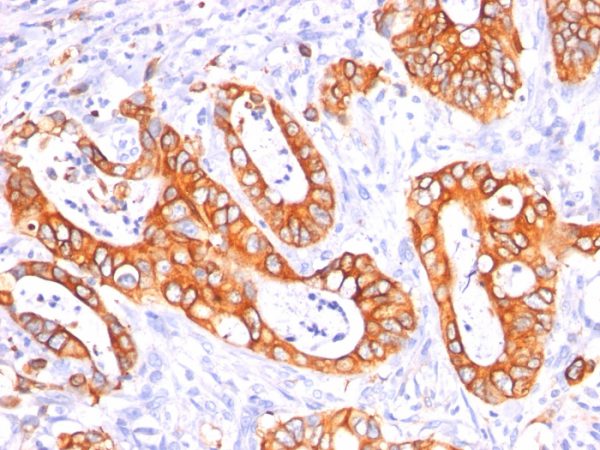 Formalin-fixed, paraffin-embedded human Colon Carcinoma stained with MUC-1 Mouse Monoclonal Antibody (GP1.4 + E29)