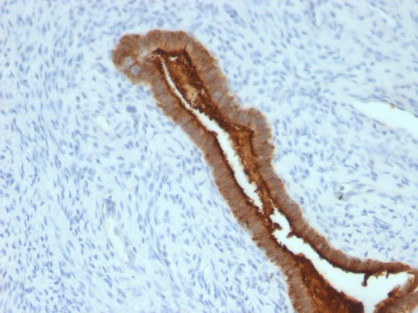 Formalin-fixed, paraffin-embedded human Endometrial Carcinoma stained with MUC-1 / CA15-3 / EMA Mouse Monoclonal Antibody (SPM492).