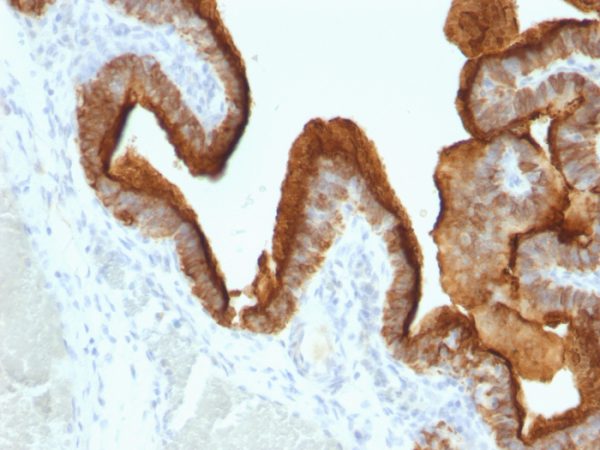 Formalin-fixed, paraffin-embedded human Ovarian Carcinoma stained with MUC-1 / CA15-3 / EMA Mouse Monoclonal Antibody (SPM493).