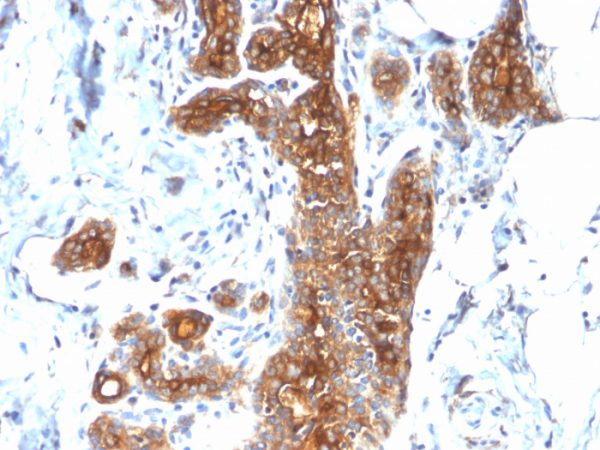 Formalin-fixed, paraffin-embedded human Breast Carcinoma stained with MUC1 Rabbit Recombinant Monoclonal Antibody (MUC1/2278R).