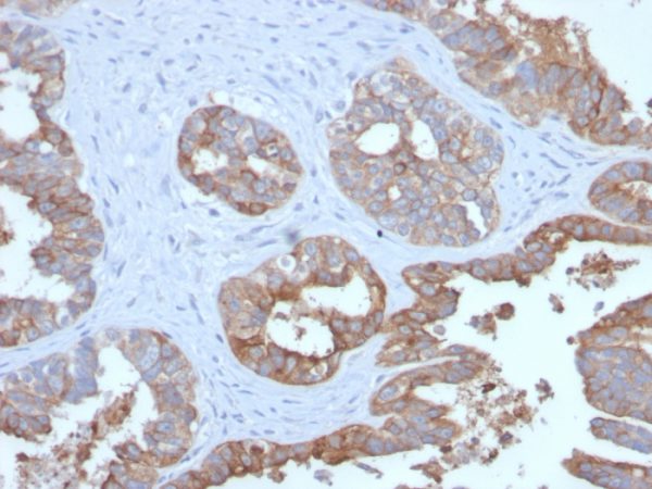 Formalin-fixed, paraffin-embedded human Prostate Carcinoma stained with MUC1 Recombinant Rabbit Monoclonal Antibody (MUC1/2729R).