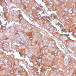 Formalin-fixed, paraffin-embedded human Colon Carcinoma stained with MUC1 Rabbit Recombinant Monoclonal Antibody (MUC1/2980R).