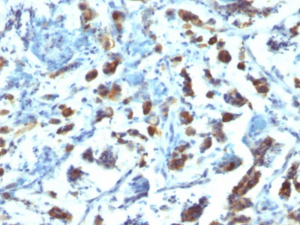 Formalin-fixed, paraffin-embedded human Gastric Carcinoma stained with MUC3 Monoclonal Antibody (SPM200).