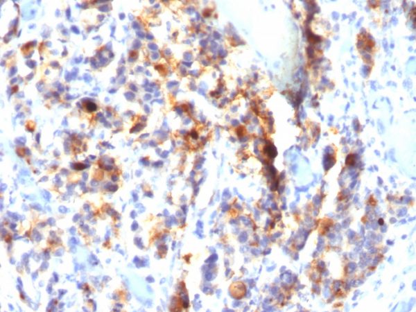 Formalin-fixed, paraffin-embedded human Gastric Carcinoma stained with MUC5AC Monoclonal Antibody (SPM297).