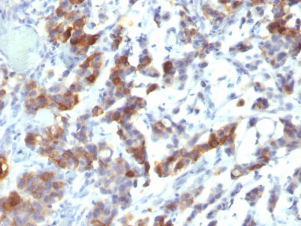 Formalin-fixed, paraffin-embedded human Gastric Carcinoma stained with MUC5AC Monoclonal Antibody (MUC5AC/917 + 45M1).