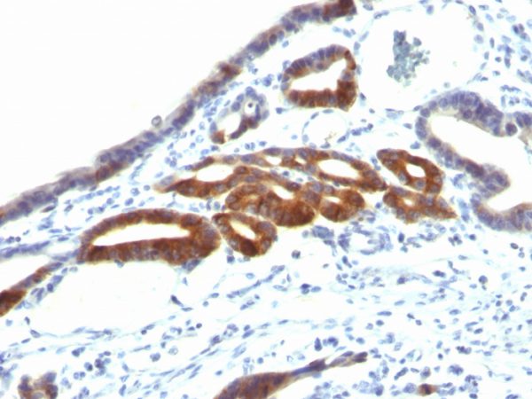 Formalin-fixed, paraffin-embedded human Gastric Carcinoma stained with MUC6 Monoclonal Antibody (SPM598).