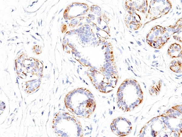 Formalin-fixed, paraffin-embedded human Breast Carcinoma stained with SM-MHC Monoclonal Antibody (SMMS-1).