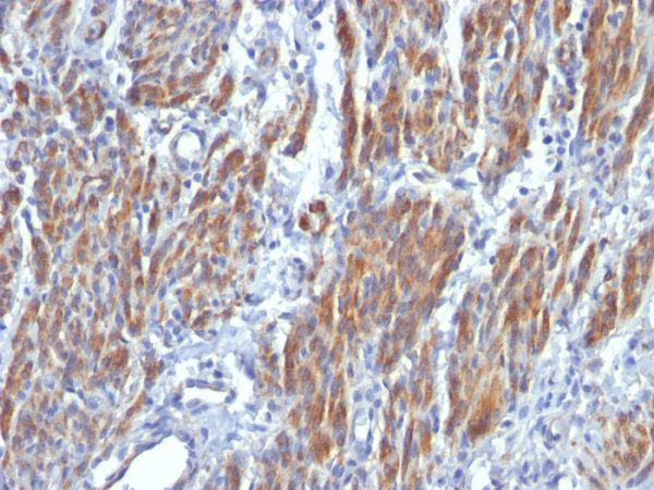 Formalin-fixed, paraffin-embedded human Leiomyosarcoma stained with SM-MHC Monoclonal Antibody (SMMS-1).